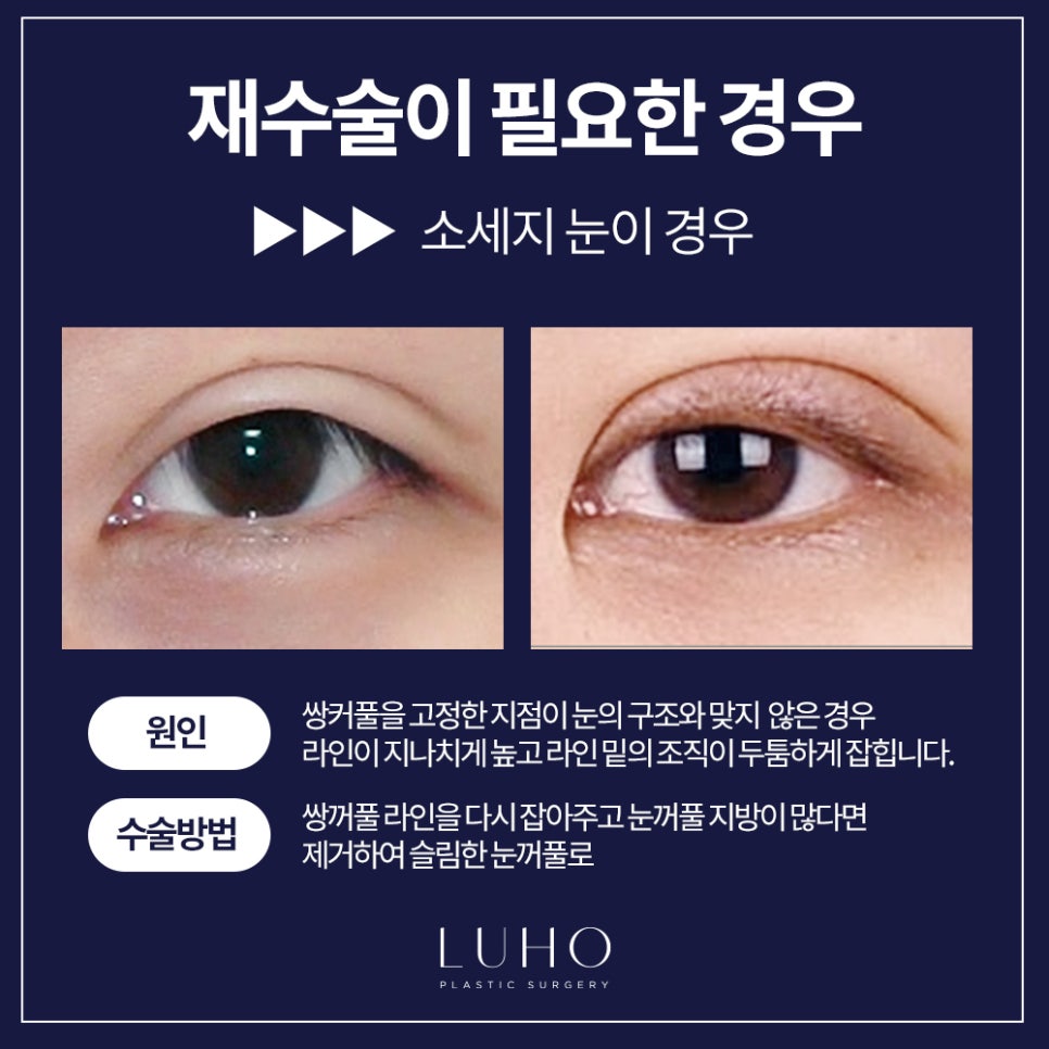 Double Eyelid Revision Surgery — Let’s Finish It at Luho! image 3