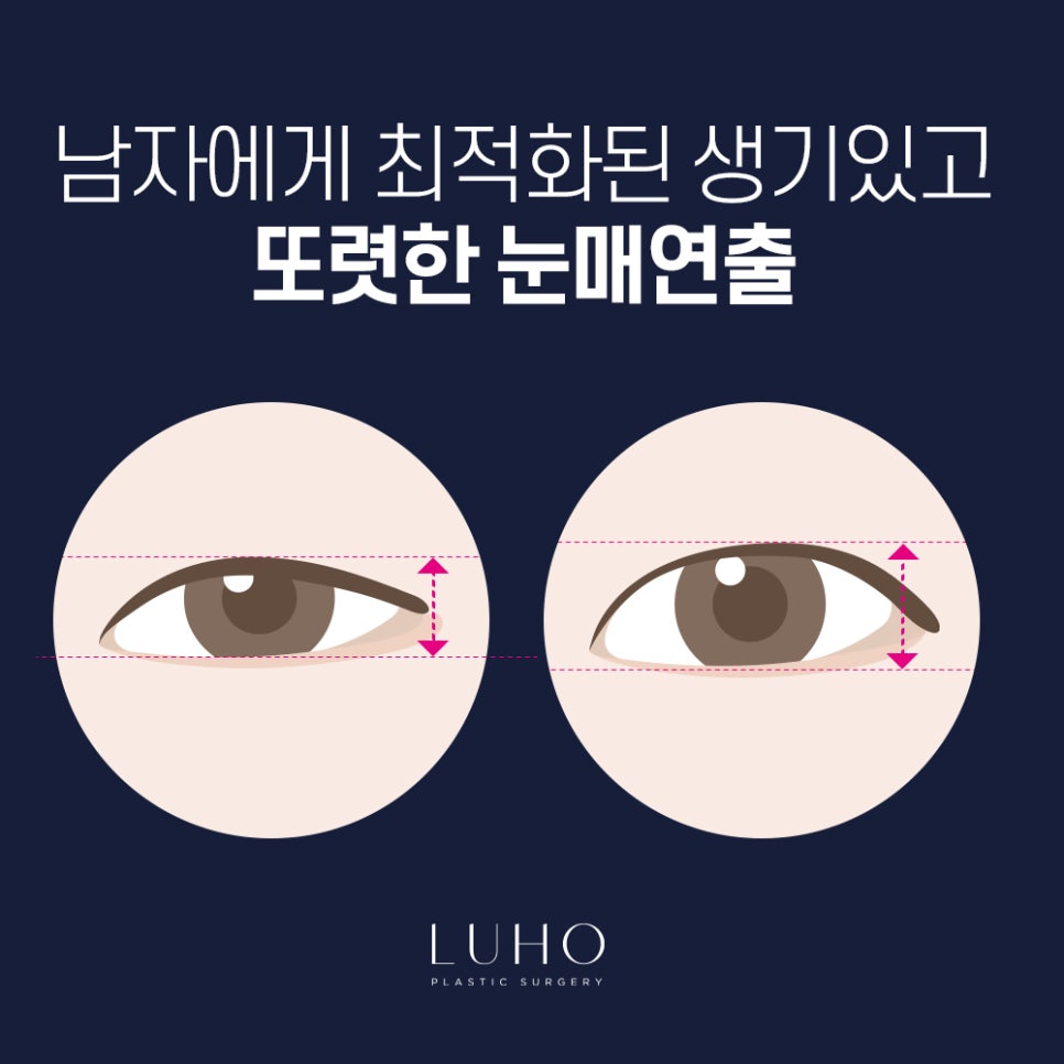 남자 안검하수를 또렷한 눈매로! 관련 이미지 3