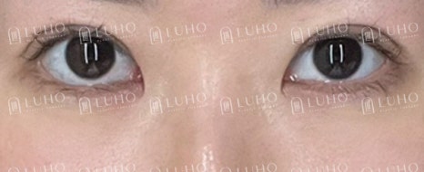 How Revision Eye Surgery Changed Uneven Eyes and a Sleepy-Looking Eye Shape image 6