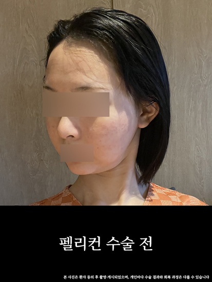 턱과 목의 경계를 찾아주는 압구정 펠리컨 수술 전후 비교 관련 이미지 3