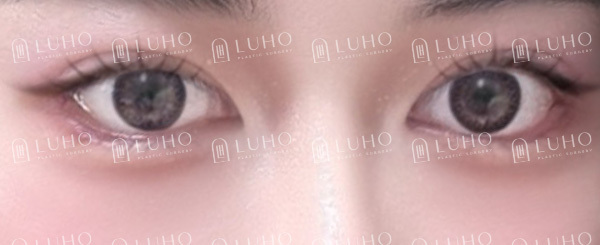 눈꼬리의 답답한 공간을 열어 방향을 바꾼 뒤밑트임 관련 이미지 7