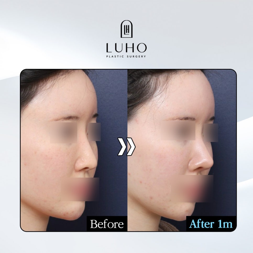 Sinsa Station Nose Revision Surgery, Real Results Correcting a Long Nose image 1
