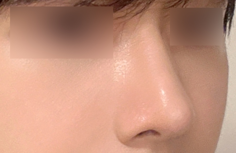 남다른 라인을 만들어 낸 신사역남자 코성형 전후 비교 관련 이미지 5