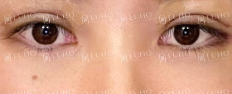 Improving an Eye Appearance That Had Lost Definition 8 Years After Buried-Suture Surgery image 7