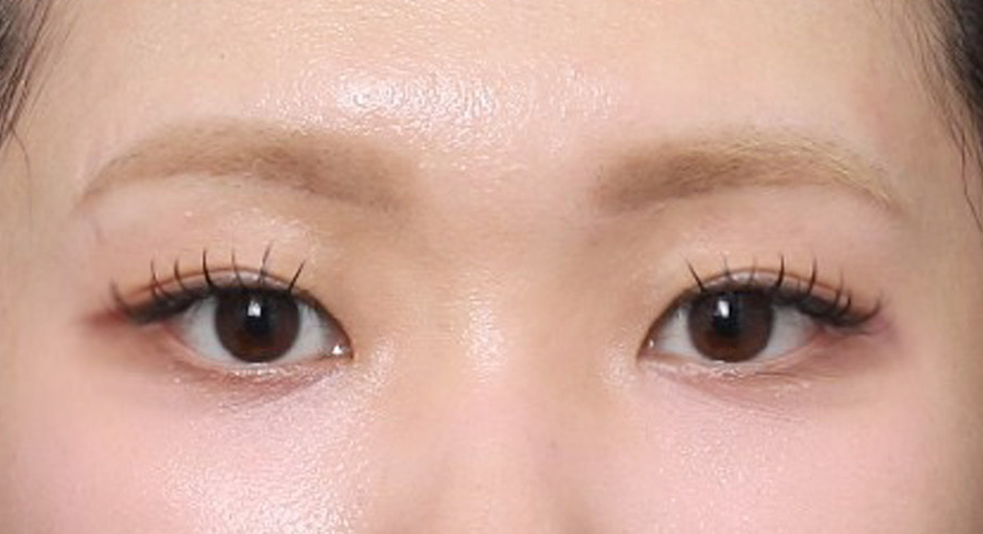 신사역 폭스아이실리프팅으로 처진 눈꼬리를 교정한 사례 관련 이미지 5
