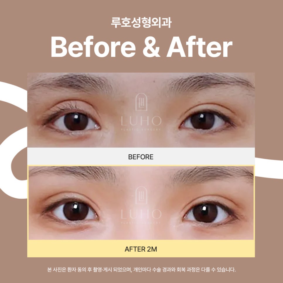 과교정된 쌍꺼풀 라인, 신사역 눈재수술 받은 개선 케이스 관련 이미지 1