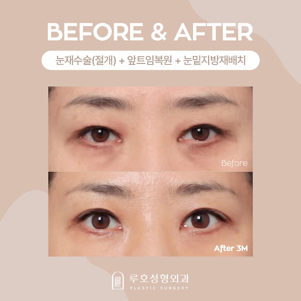 Middle-Aged Eye Surgery at Luho Plastic Surgery, Sinsa Station image 1