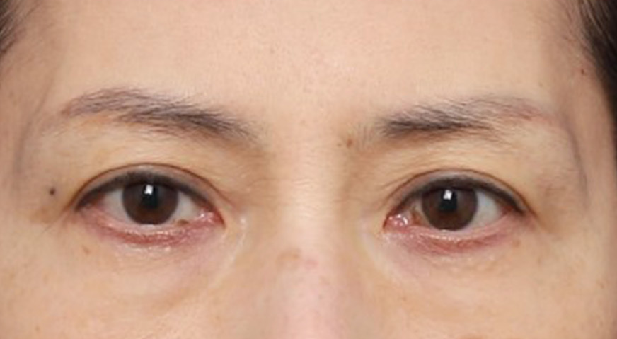 처진 눈매 흐름을 바꿔준 신사역 눈꼬리 실리프팅 관련 이미지 3