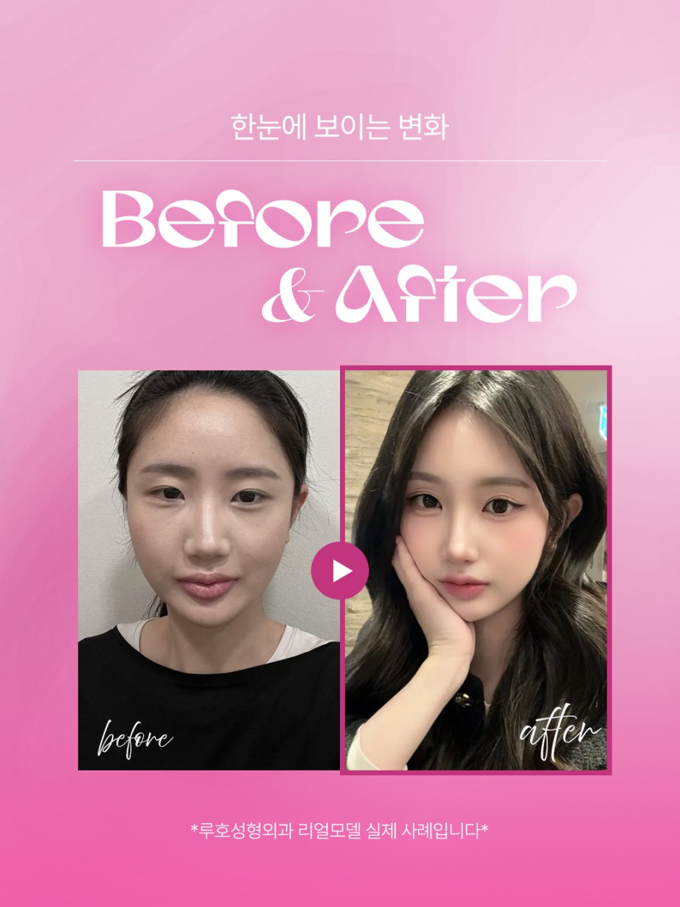 [Sinsa Station Plastic Surgery] Luho Plastic Surgery Real Model Recruitment image 2