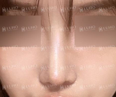 화려하고 또렷한 코 라인으로 개선한 수술 후기 관련 이미지 11