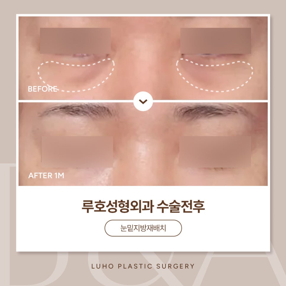 Effect of Under-Eye Fat Repositioning at Sinsa Station: A Reduced Dark Circle Appearance image 1
