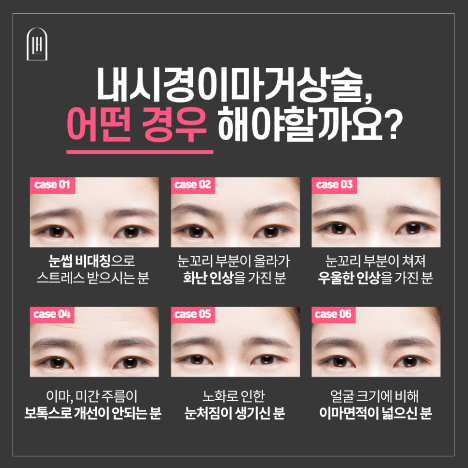Endoscopic Forehead Lift image 3