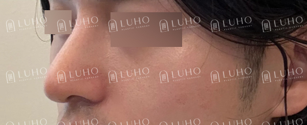코 필러 후에도 고민이 남은 코라인 개선한 남자 코재수술 관련 이미지 9