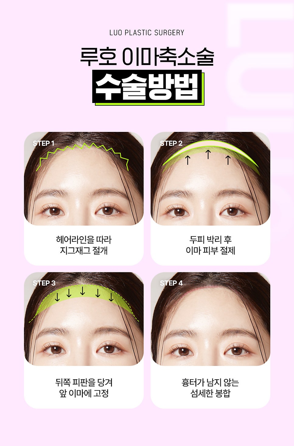이마축소수술 전후사진 비교｜자연스러운 헤어라인 교정 후기 관련 이미지 4