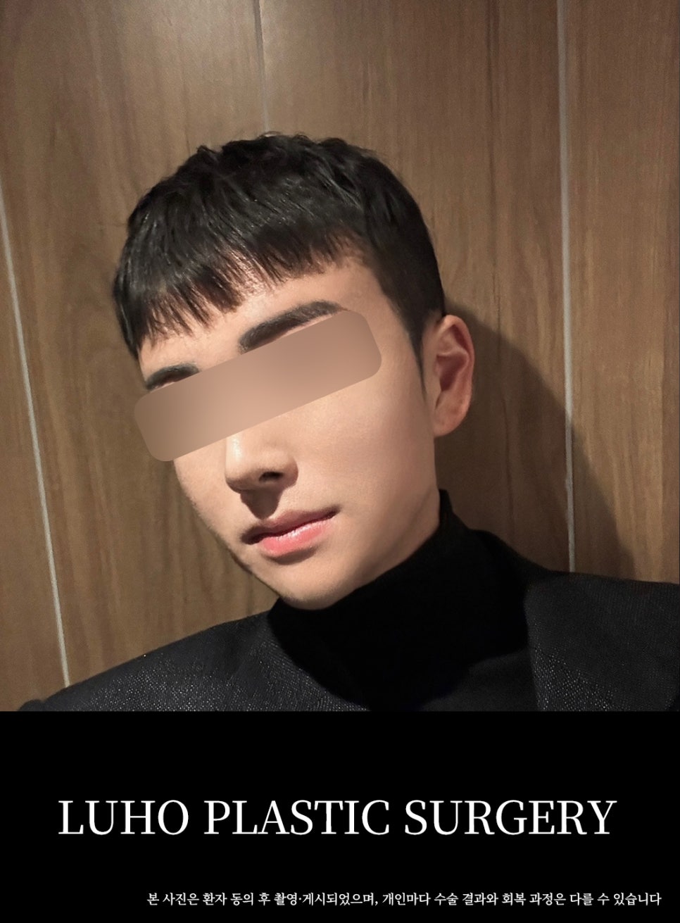 Real Before-and-After Review of Male Rhinoplasty at Luho Plastic Surgery Near Sinsa Station image 5