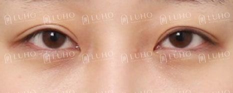 과거 수술 후 졸려 보이던 눈매를 교정한 눈재수술 관련 이미지 5