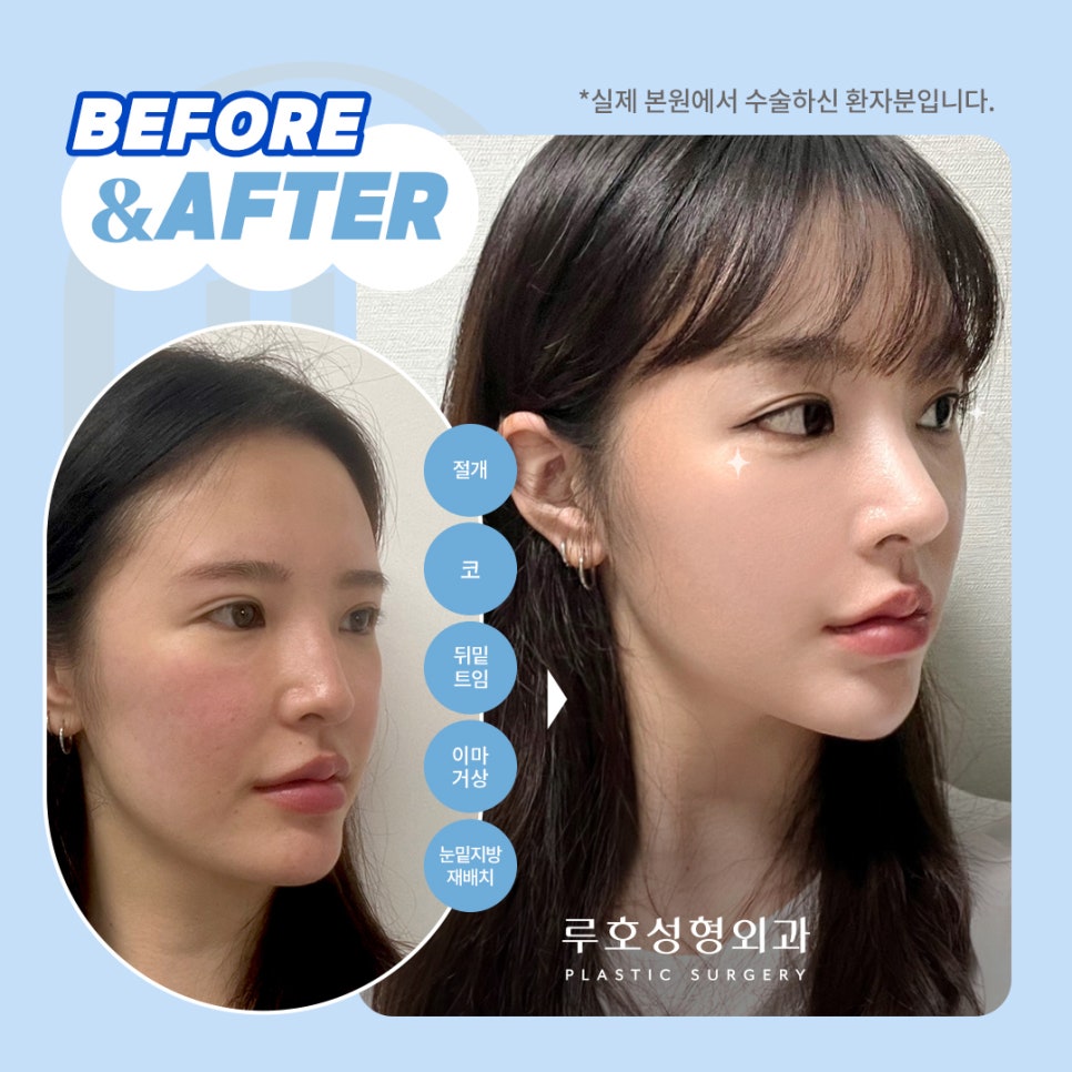 ［루호성형외과］수술 전/후 사진 비교하기 관련 이미지 3