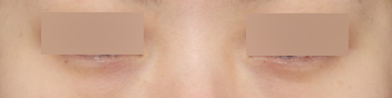 How to Get Rid of Dark Circles: A Look at Under-Eye Fat Repositioning Reviews Near Sinsa Station image 6
