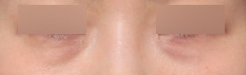 Dark Under-Eye Areas: A Review of Changes with Under-Eye Fat Repositioning at Sinsa Station image 2