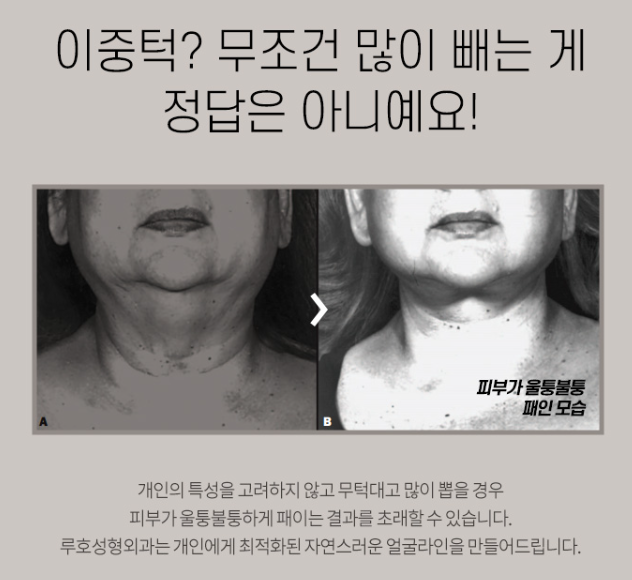 고민되는 턱살, 신사역 턱살지방흡입으로 달라진 라인 완성! 관련 이미지 6