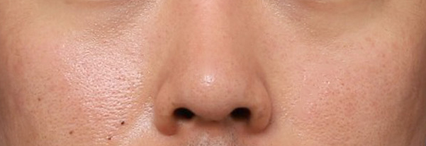 A Shinsegae Station Nose Surgery Review That Sharpened the Center of the Face with Tip Reduction image 5