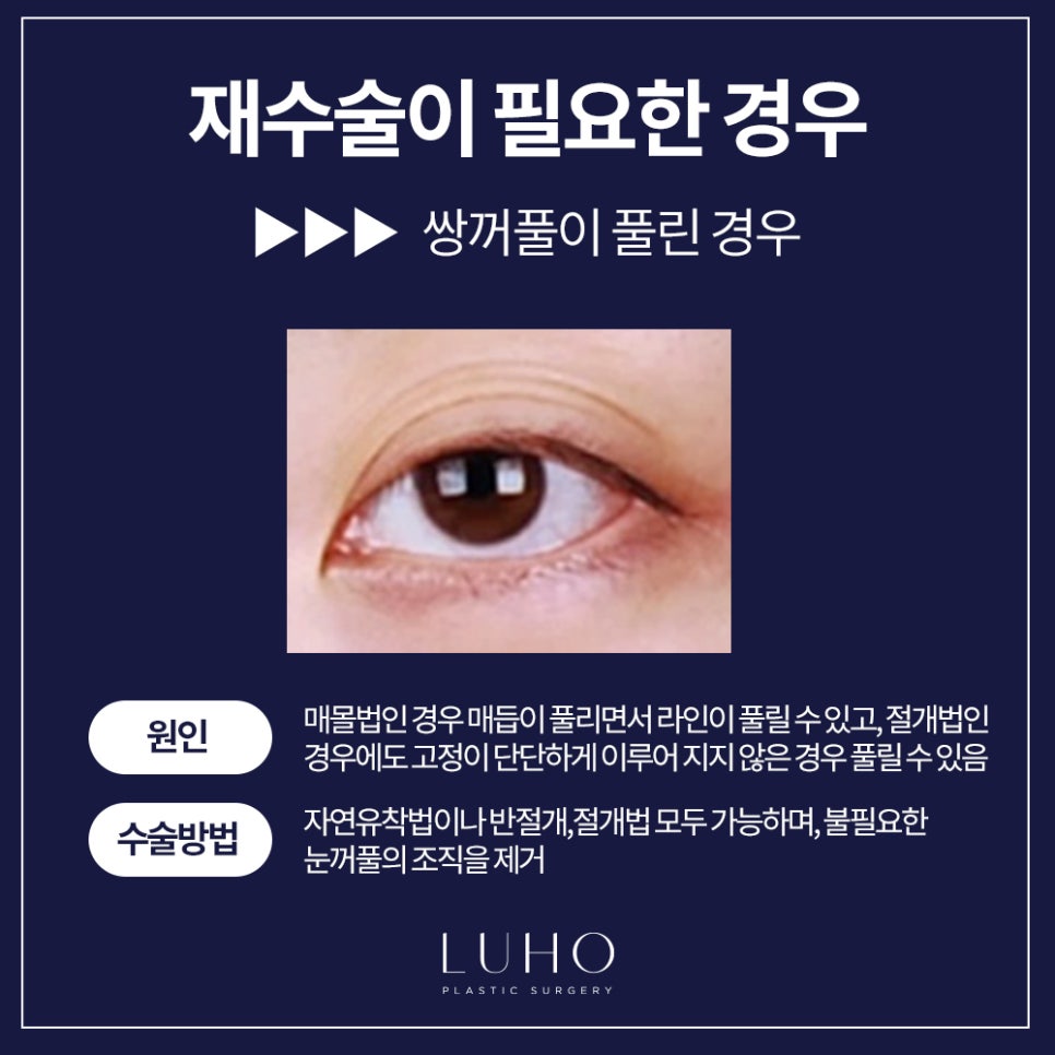 Double Eyelid Revision Surgery — Let’s Finish It at Luho! image 5