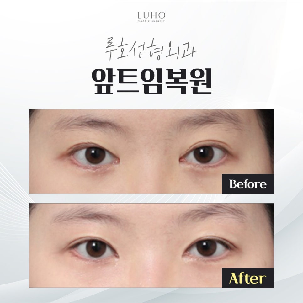 나에게 어울리는 눈매를 완성한 신사역 앞트임 복원 후기 관련 이미지 1