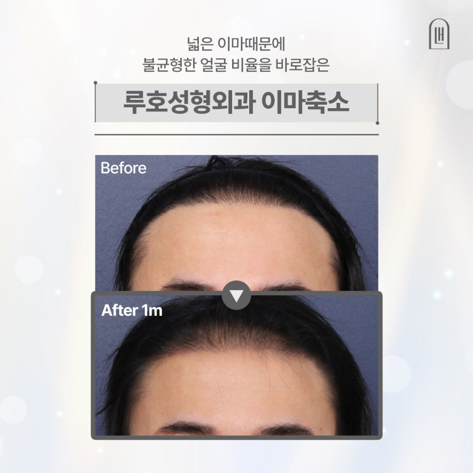 헤어라인을 내리면서 얼굴 비율을 개선한 남자 이마축소 사례 관련 이미지 1