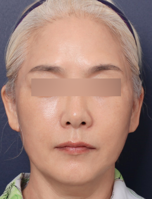 A Case of Facelift Surgery at Sinsa Station That Restored Weakened Midface Support image 5