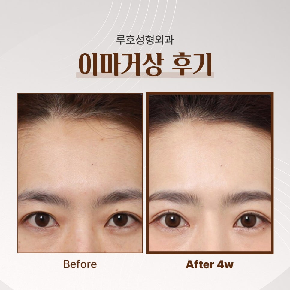 A Review of Forehead Lift Surgery at Sinsa Station That Completed a Natural Youthful Look image 1