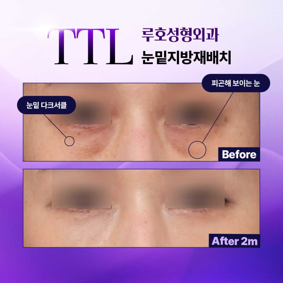 Sinsa Station Dark Circle Under-Eye Fat Repositioning Effect: A Review of Finding and Removing the Real Cause image 1
