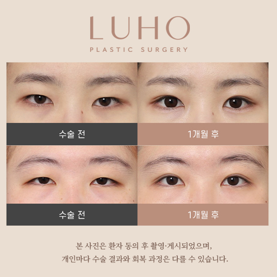신사역 졸린 눈 눈매교정 전후 살펴보기 관련 이미지 1