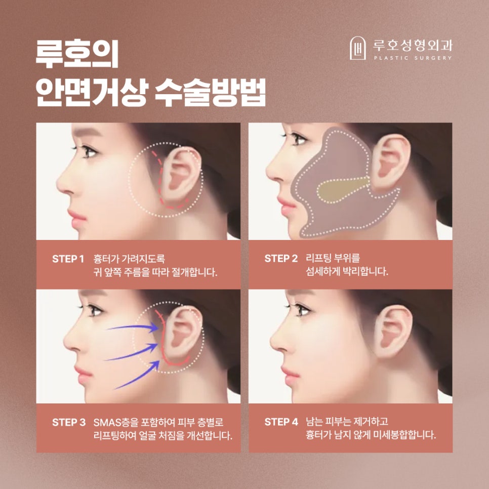 Before and After Reveal of a Refined Jawline at a Place Known for Facelift Surgery Near Sinsa Station image 4