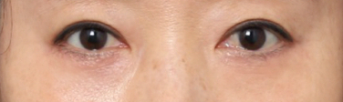 A Look at How Middle-Aged Eye Surgery at Sinsa Station Changes the Eye Shape image 5