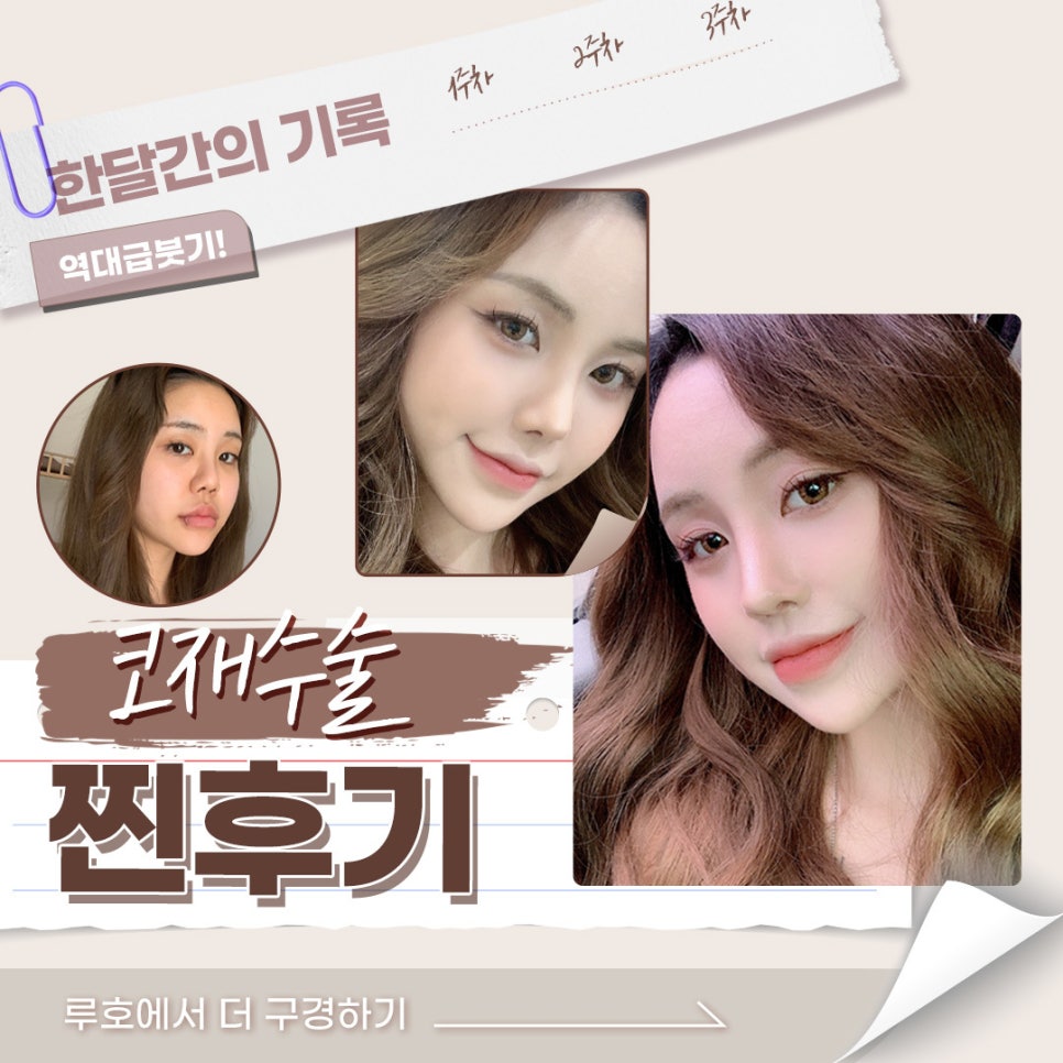 루호성형외과 마지막 코재수술 관련 이미지 1