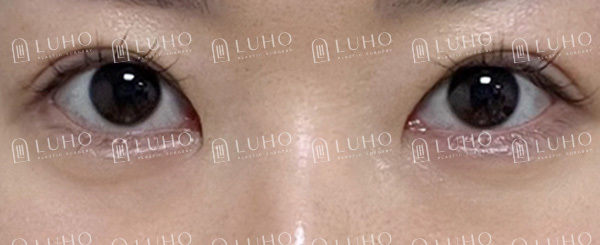 How Revision Eye Surgery Changed Uneven Eyes and a Sleepy-Looking Eye Shape image 7