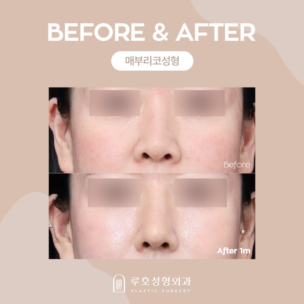 Hump Nose Surgery: Why Is It Needed? image 1