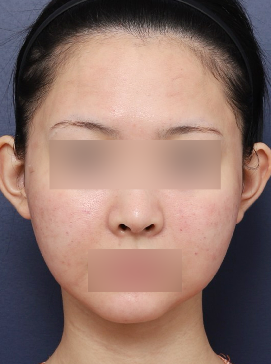 이중 턱살 제거한 신사역 펠리컨 수술 전후 관련 이미지 2