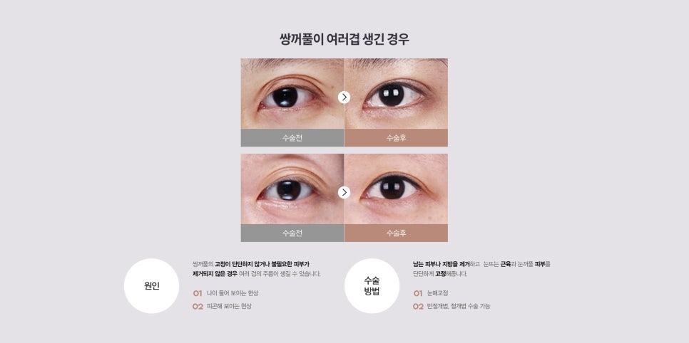 눈 수술법의 종류와 회복기간 #2 관련 이미지 12
