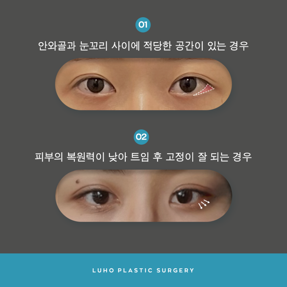[루호성형외과] 작은 눈도 종류가 있다? 이런 분들은 꼭 트임 눈성형 하세요 관련 이미지 6