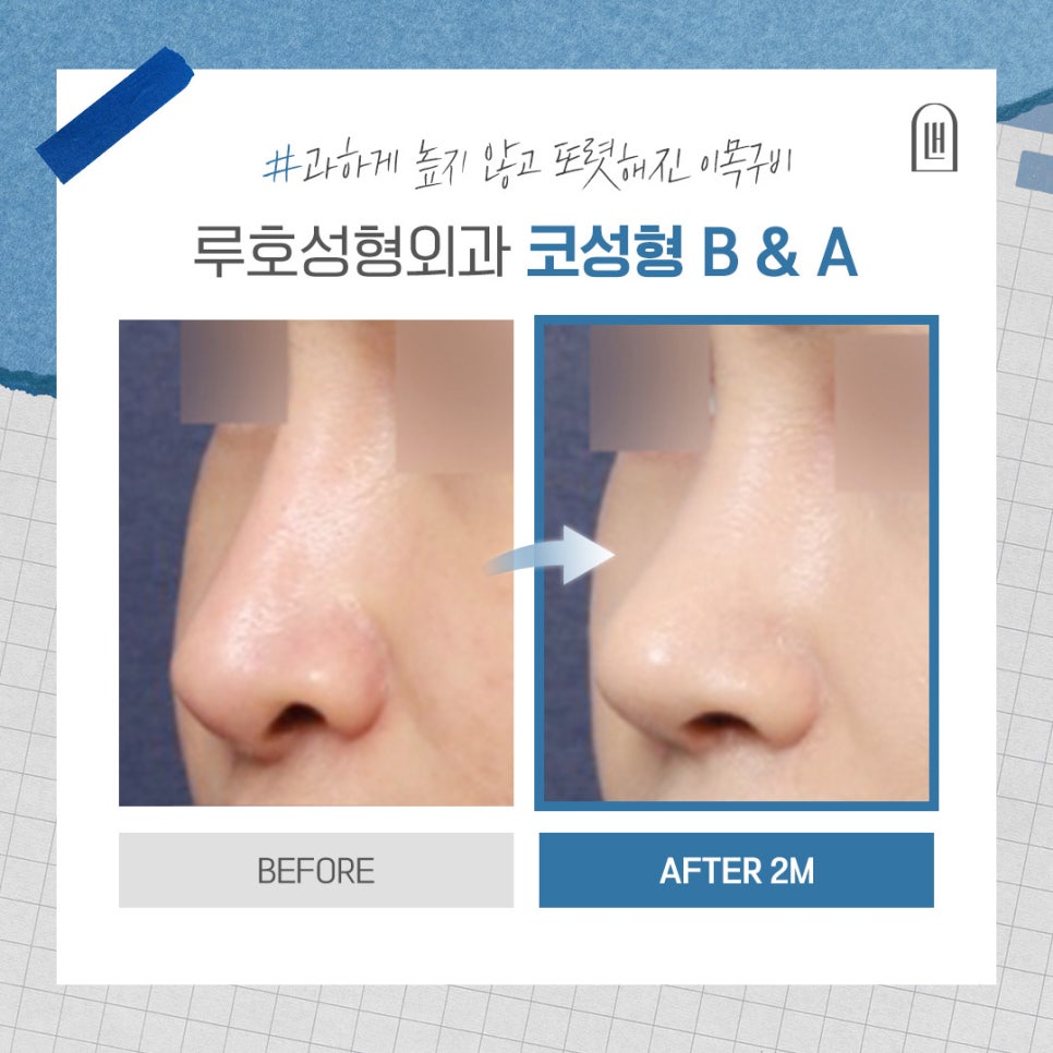 얼굴과의 조화를 맞춘 코성형, 전후 변화 살펴보기 관련 이미지 1
