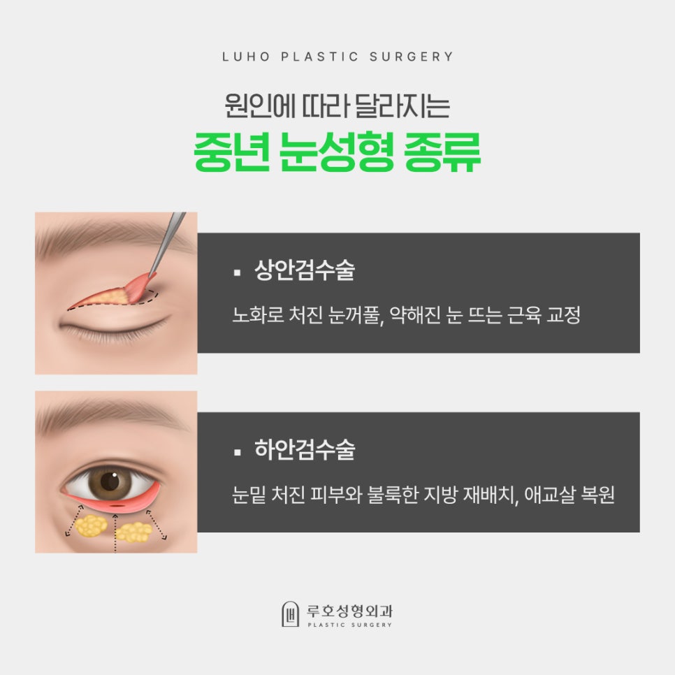 무거운 눈밑을 가볍게 바꿔준 하안검수술 효과 살펴보기 관련 이미지 2