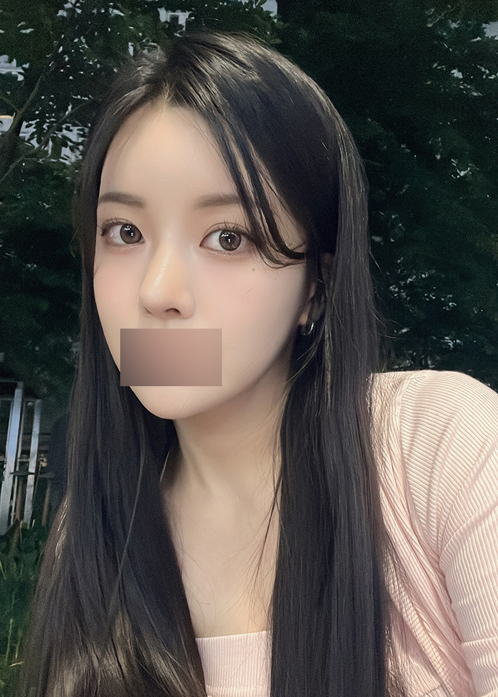 신사 얼굴지방이식 효과, 전후 비교 후기 관련 이미지 5