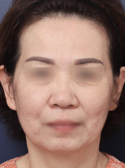 [Sinsa Station Facelift Plastic Surgery Clinic] Looking at a Case of Improved Jowl Sagging image 2