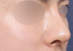 A Real Review of Men’s Rhinoplasty at Sinsa Station That Completed a Masculine Line image 5