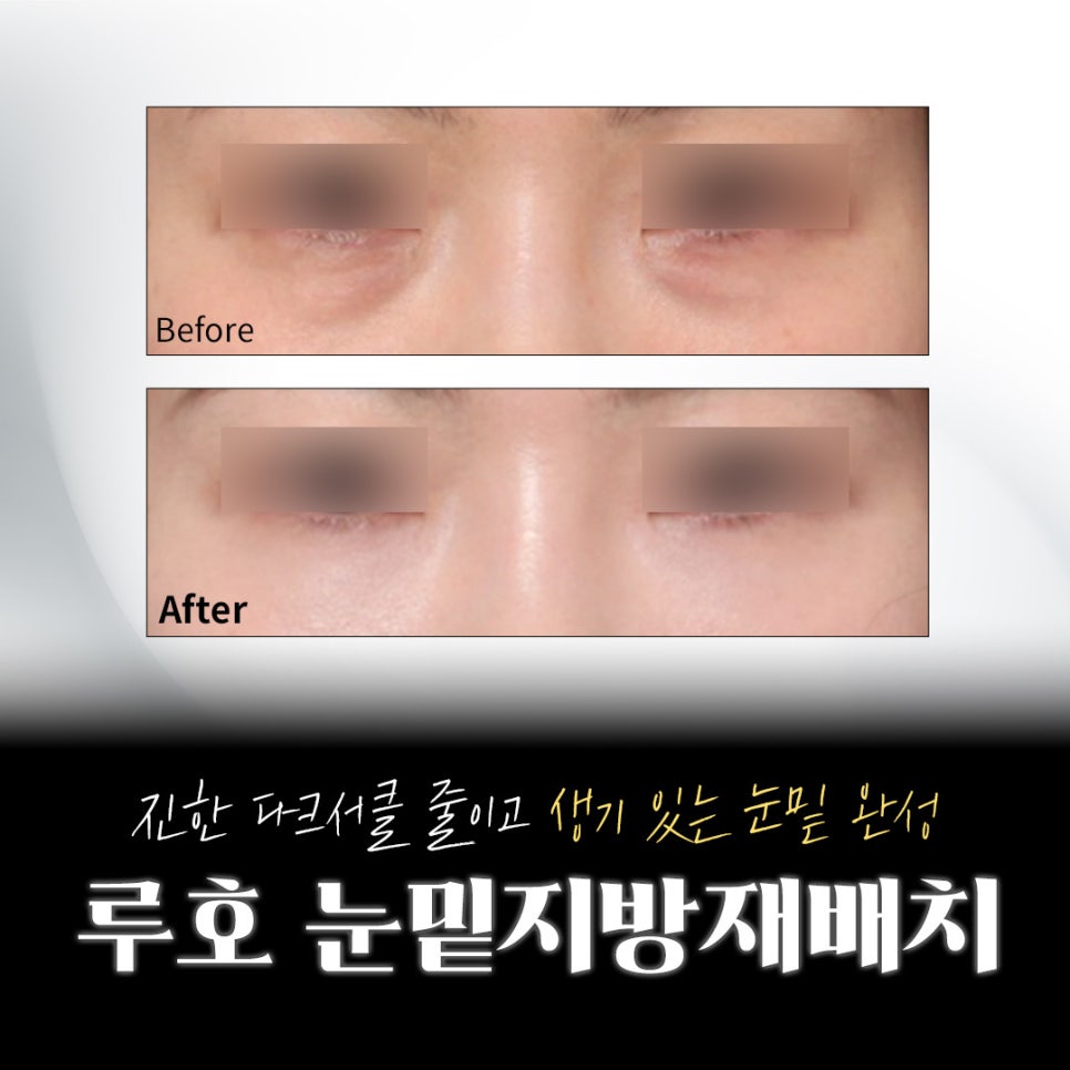 Reduce Deep Dark Circles and Brighten the Eye Area with Under-Eye Fat Repositioning at Sinsa Station image 1