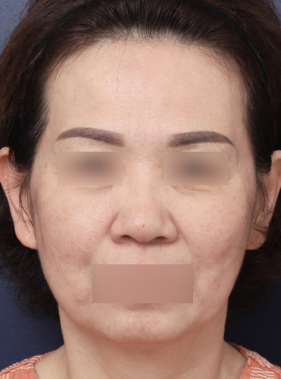 처진 얼굴선이 고민이었던 안면거상 사례 관련 이미지 3
