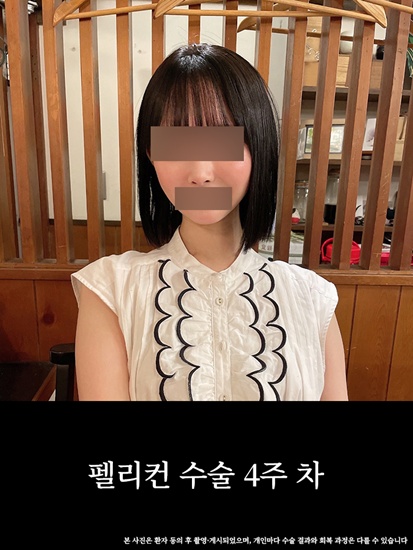 턱과 목의 경계를 찾아주는 압구정 펠리컨 수술 전후 비교 관련 이미지 5