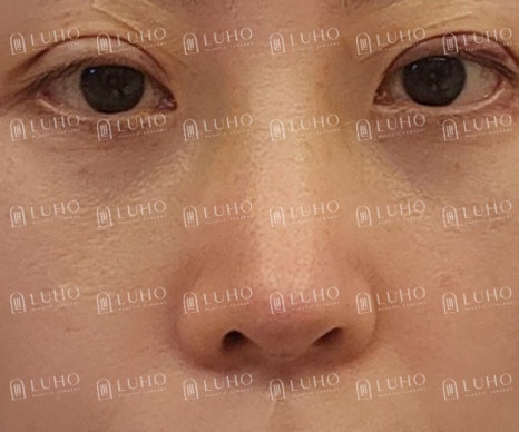 A Review of Eye & Nose Revision Surgery That Addressed the Shortcomings of Previous Surgery image 5