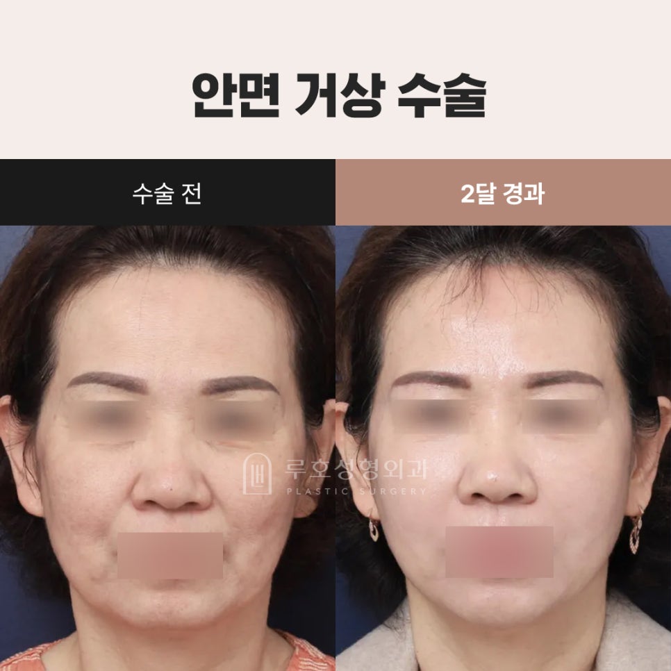 [Sinsa Station Facelift Plastic Surgery Clinic] Looking at a Case of Improved Jowl Sagging image 1
